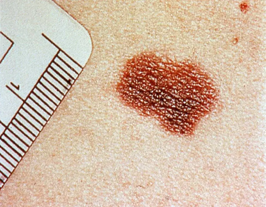 La vacuna experimental del melanoma, entre la expectación y la cautela por falta de datos